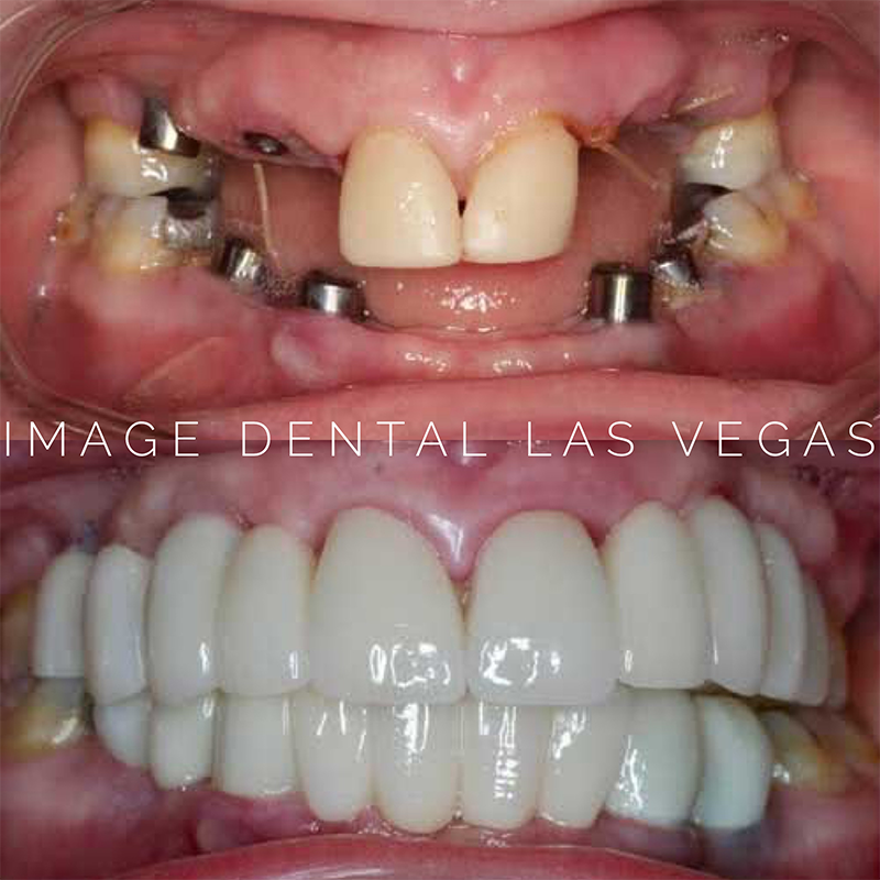 Dentures in Las Vegas